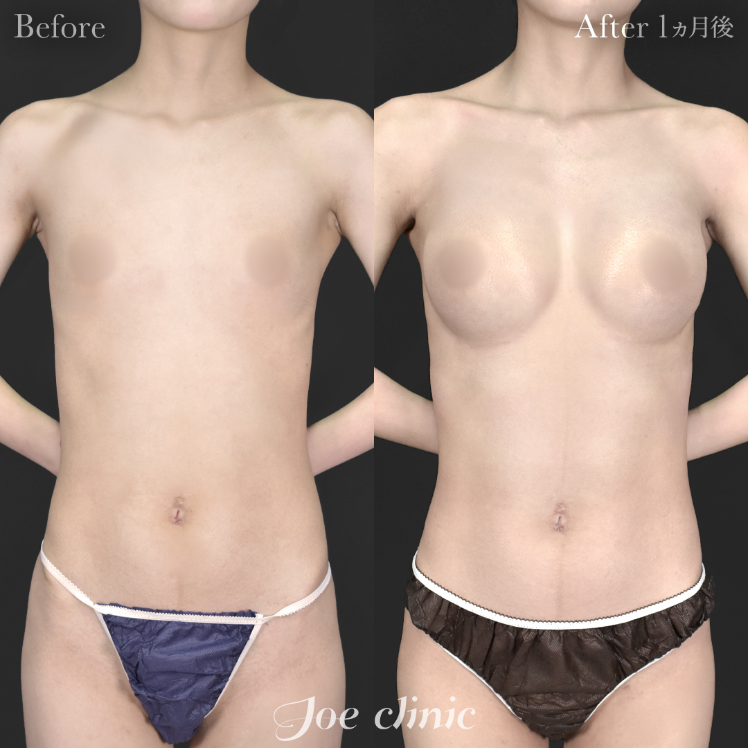 【20代女性】ハイブリッド豊胸(シリコンバッグ豊胸+脂肪幹細胞注入豊胸)|1ヵ月後