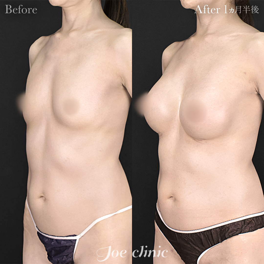 【40代女性】ハイブリッド豊胸（シリコンバッグ豊胸＋脂肪幹細胞注入豊胸）胸下切開法｜1ヵ月半後