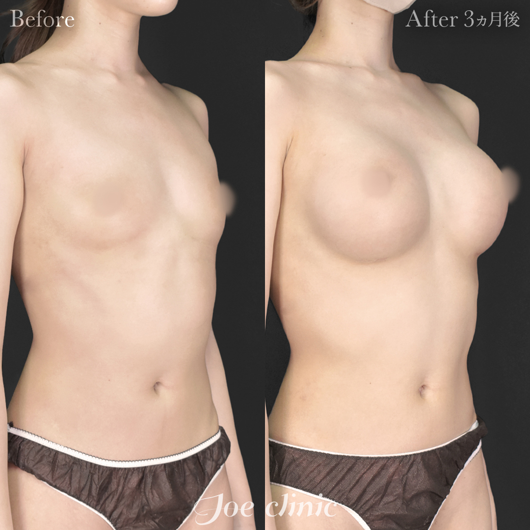 【20代女性】シリコンバッグ豊胸モティバ2（290cc×左右） 胸下切開法｜3ヵ月後
