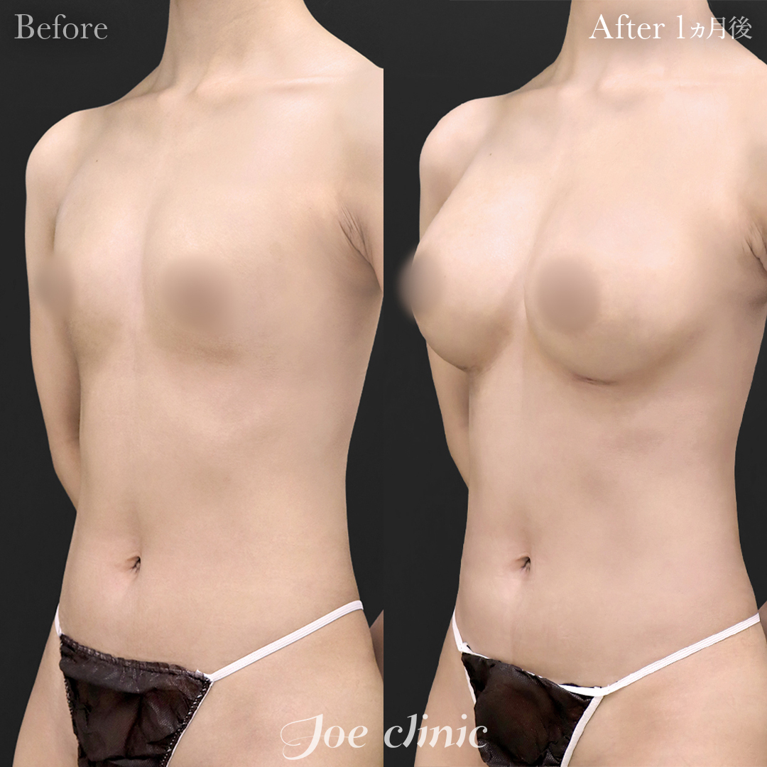 【20代女性】シリコンバッグ豊胸モティバ2（270cc×左右） 胸下切開法｜1ヵ月後
