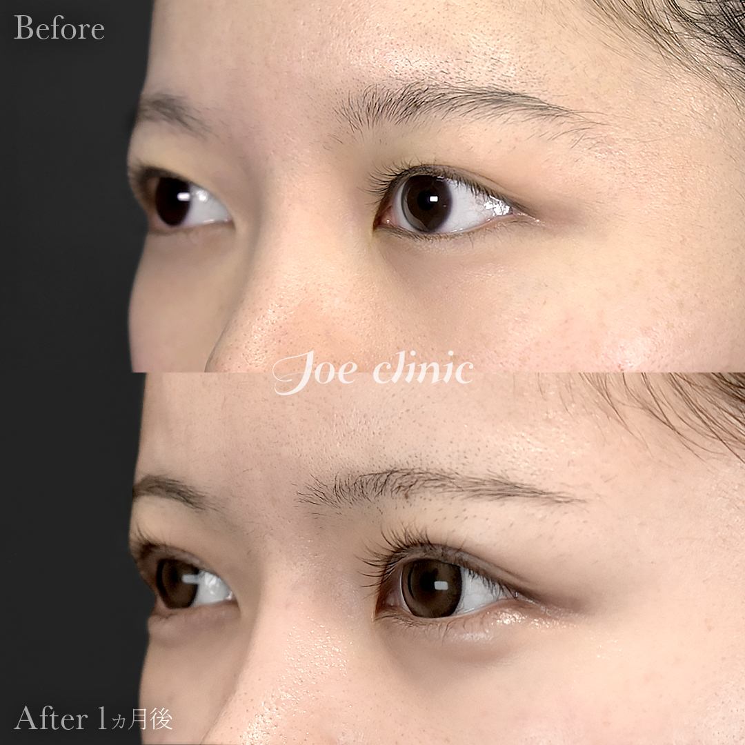 【20代女性】二重部分切開法+脂肪取り術|1ヵ月後