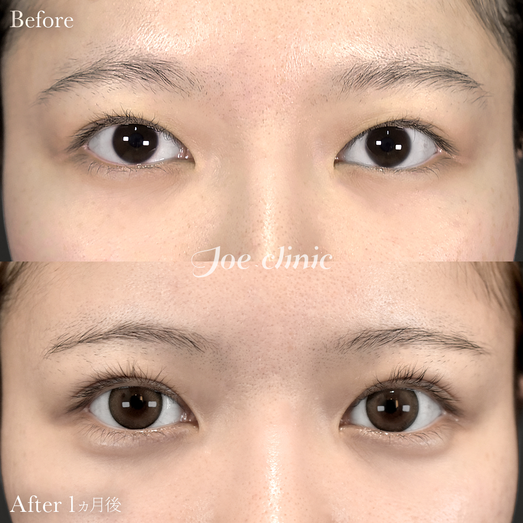 【20代女性】二重部分切開法+脂肪取り術|1ヵ月後