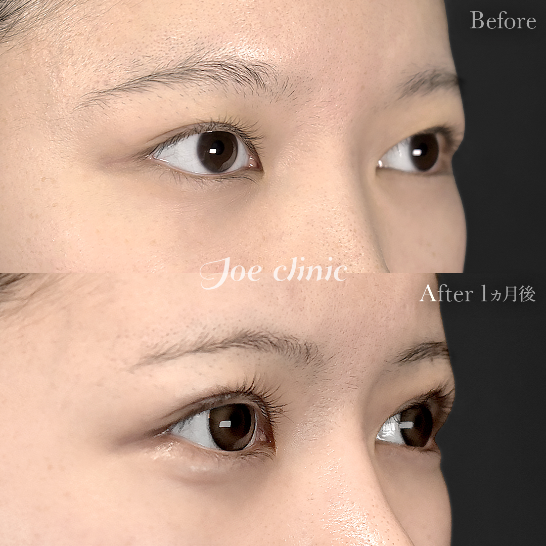 【20代女性】二重部分切開法+脂肪取り術|1ヵ月後