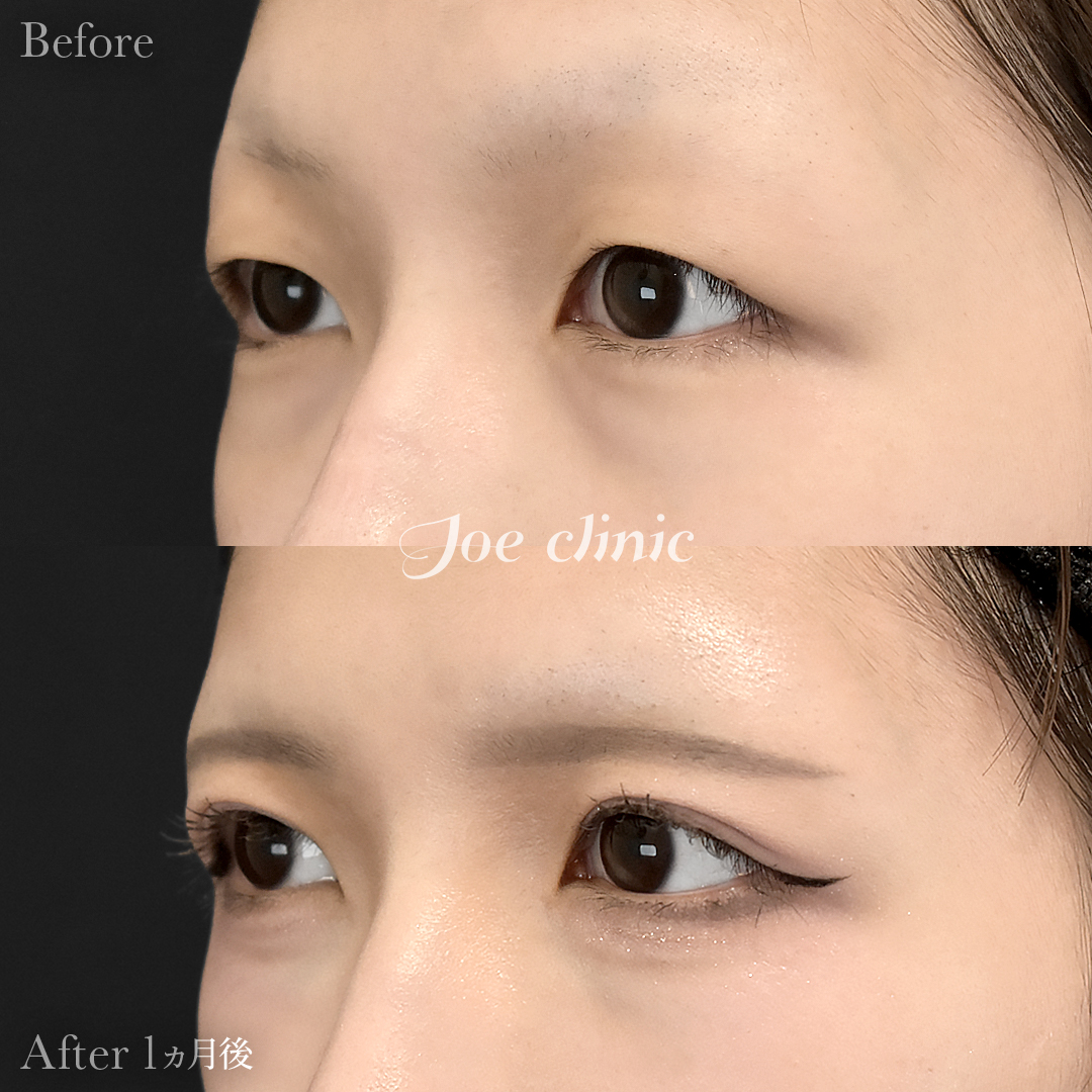 【30代女性】二重全切開法|1ヵ月後