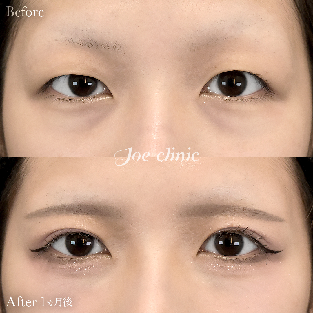 【30代女性】二重全切開法|1ヵ月後