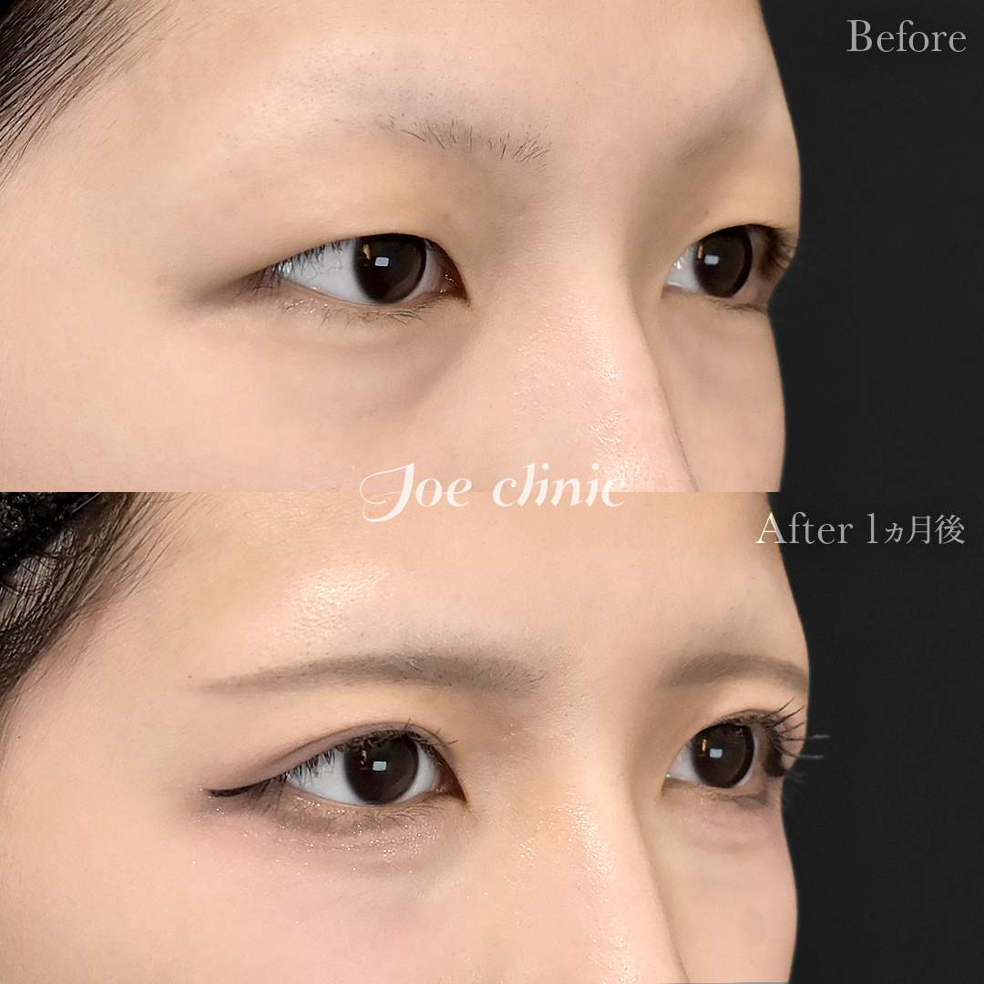 【30代女性】二重全切開法|1ヵ月後