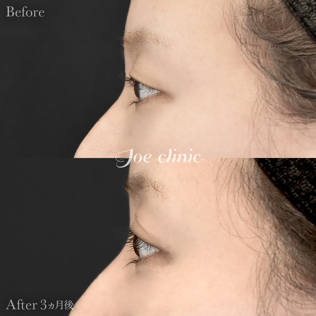 【30代女性】二重全切開法|3ヵ月後