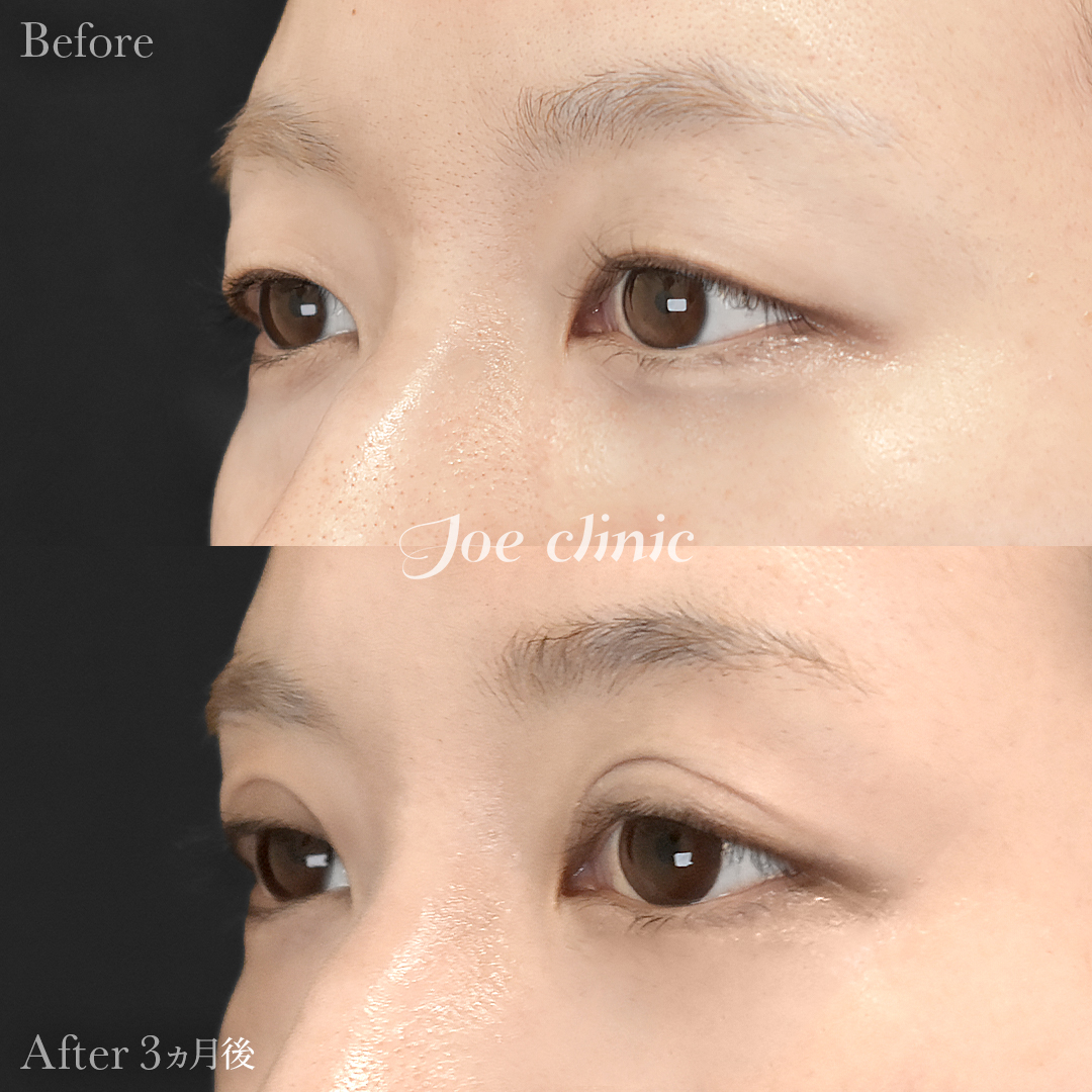 【30代女性】二重全切開法|3ヵ月後