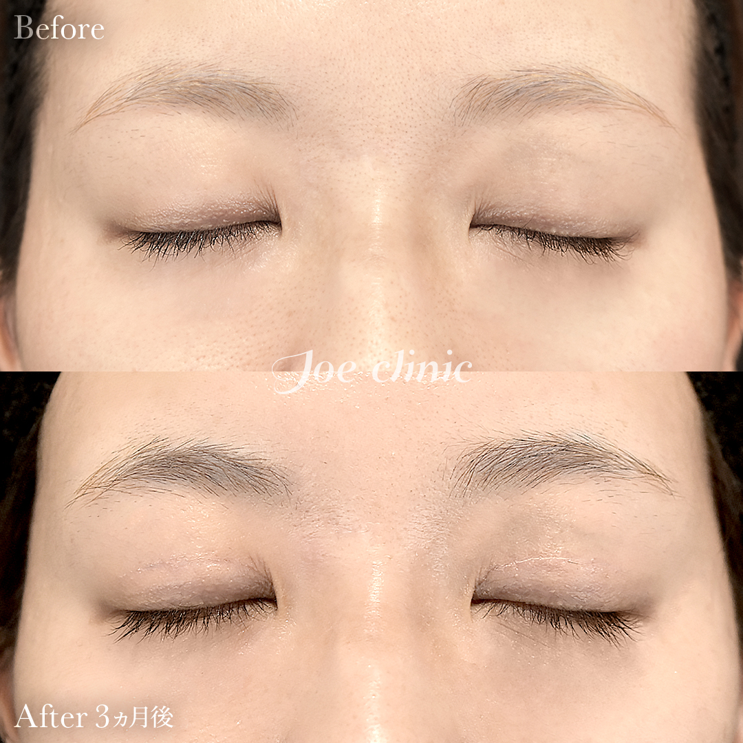 【30代女性】二重全切開法|3ヵ月後