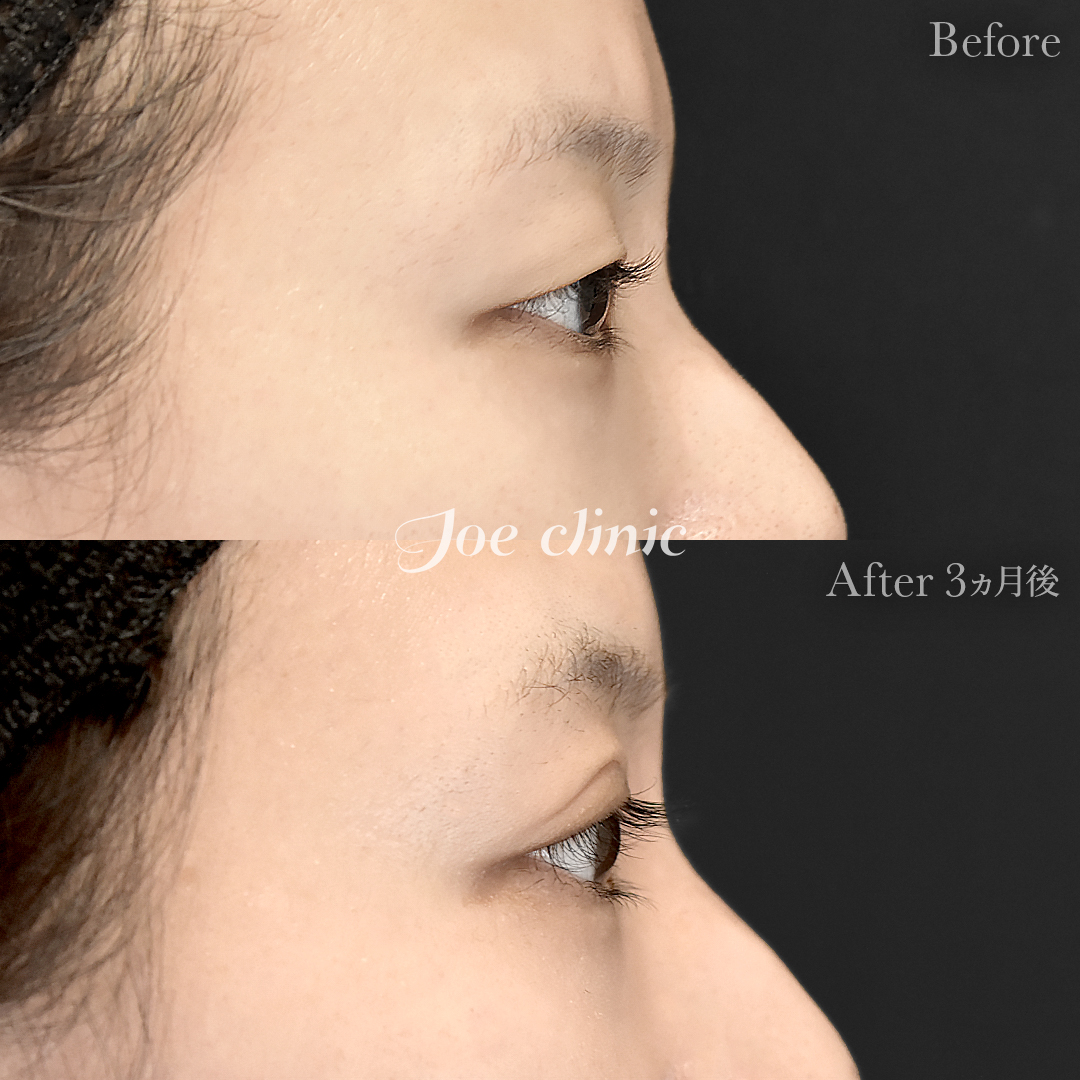 【30代女性】二重全切開法|3ヵ月後