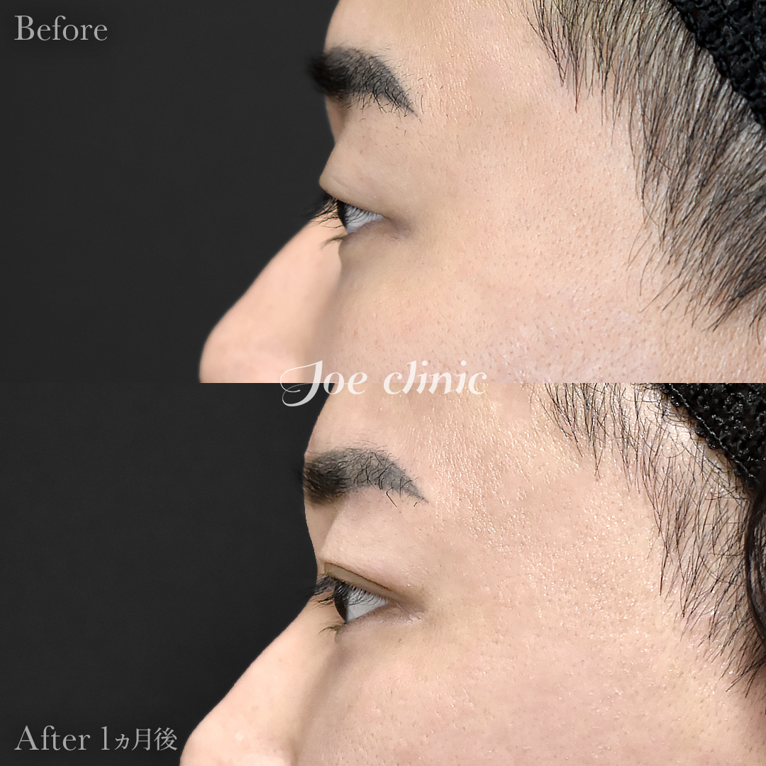 【20代男性】韓国式二重埋没法6点留め|1ヵ月後