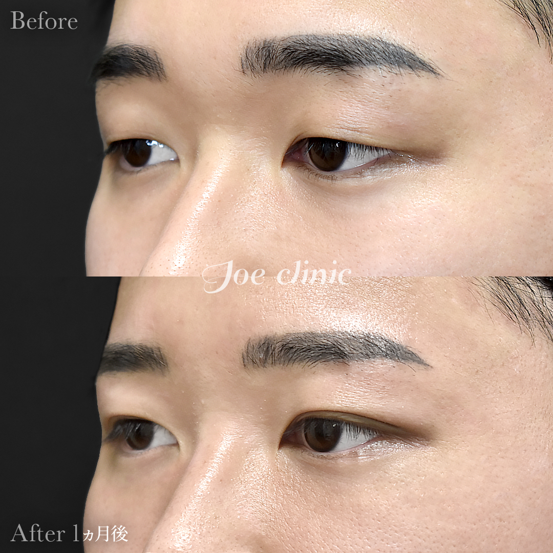 【20代男性】韓国式二重埋没法6点留め|1ヵ月後