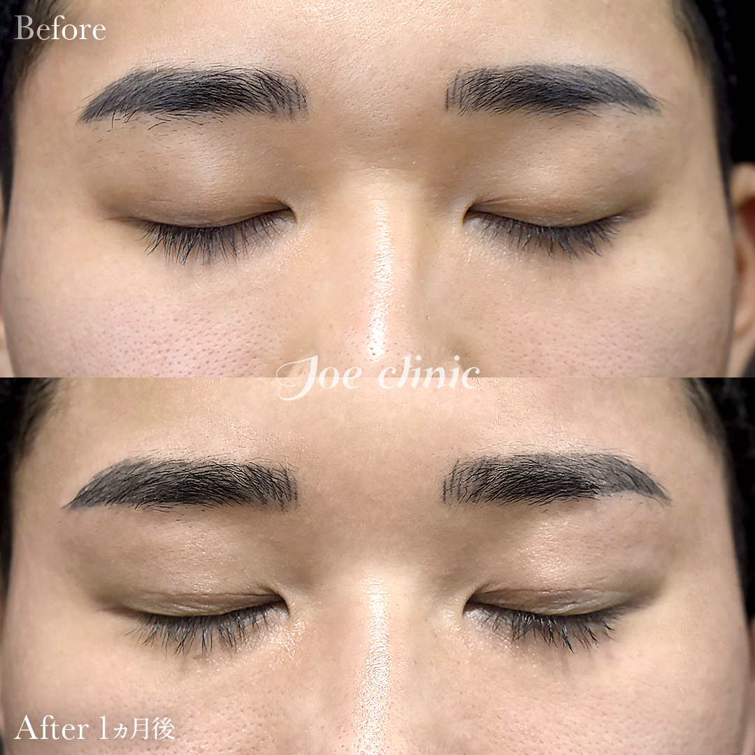 【20代男性】韓国式二重埋没法6点留め|1ヵ月後