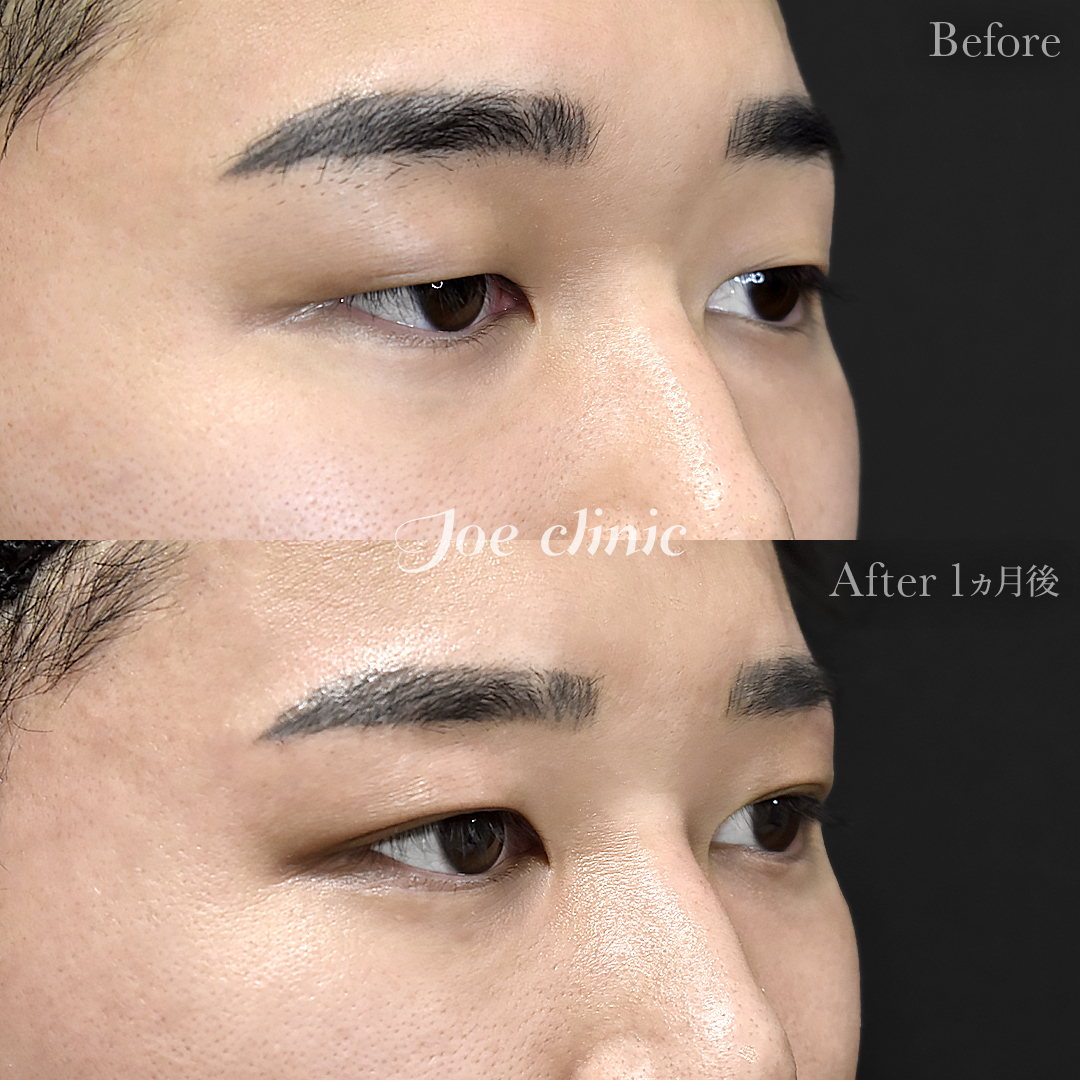 【20代男性】韓国式二重埋没法6点留め|1ヵ月後