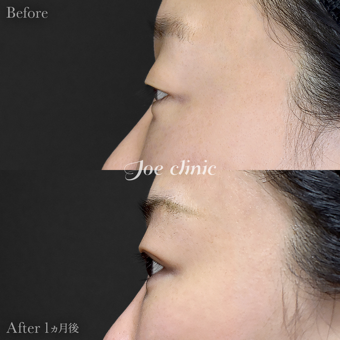 【30代女性】韓国式二重埋没法6点留め｜1ヵ月後