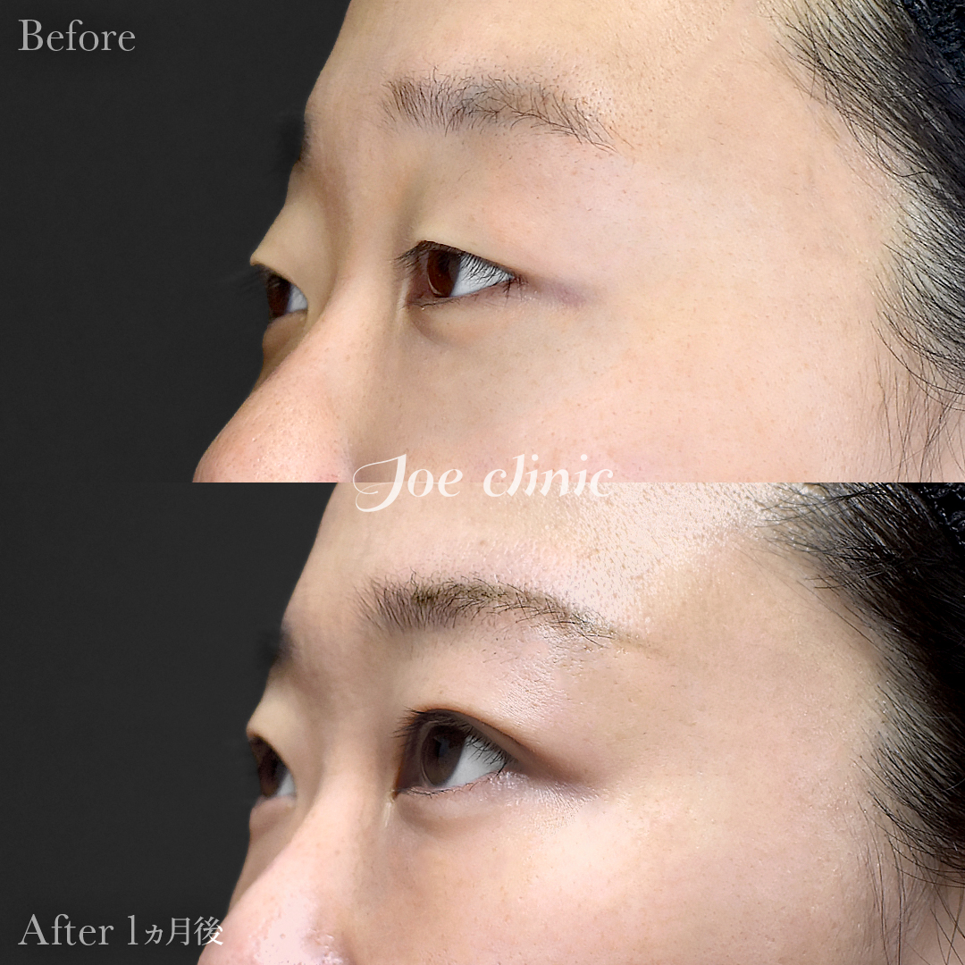 【30代女性】韓国式二重埋没法6点留め｜1ヵ月後