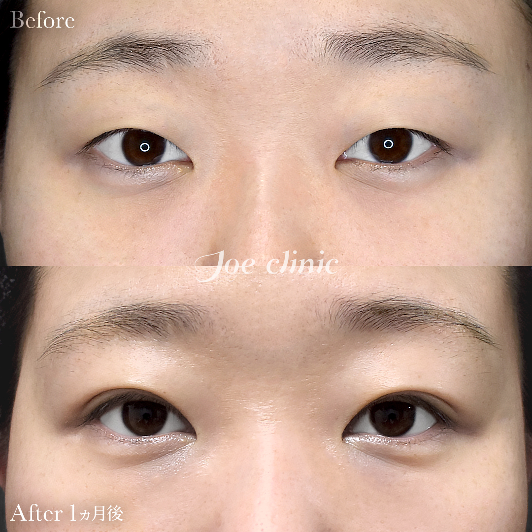 【30代女性】韓国式二重埋没法6点留め｜1ヵ月後