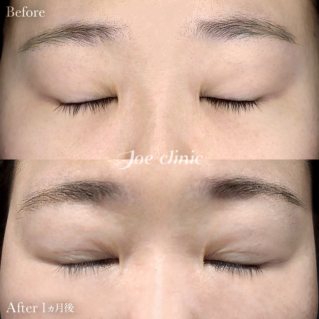 【30代女性】韓国式二重埋没法6点留め｜1ヵ月後