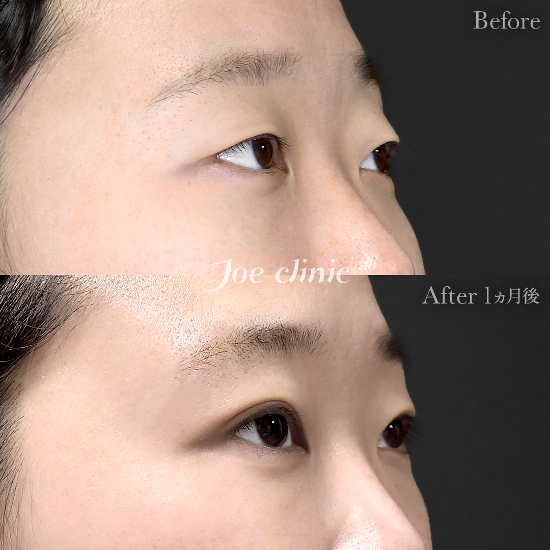 【30代女性】韓国式二重埋没法6点留め｜1ヵ月後