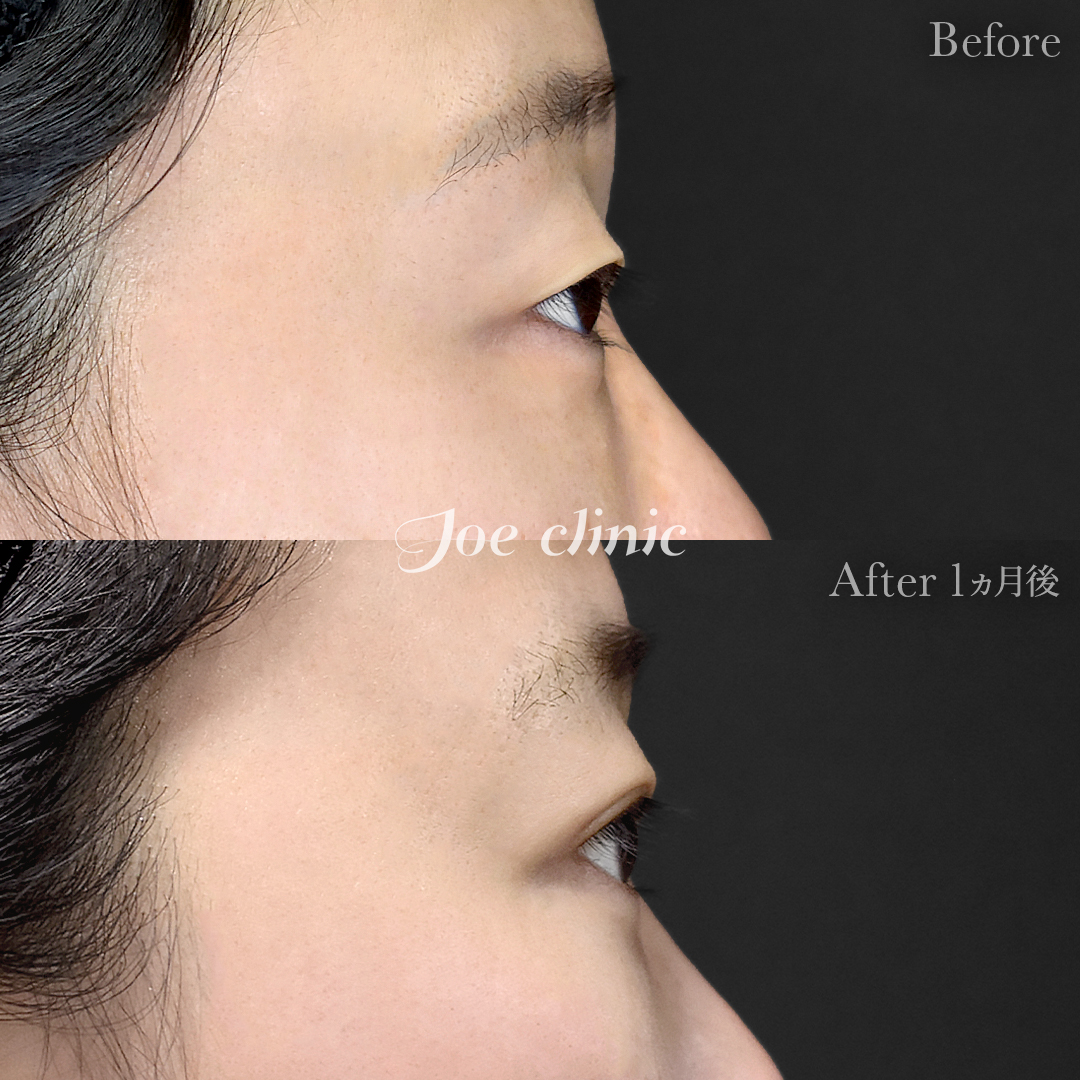 【30代女性】韓国式二重埋没法6点留め｜1ヵ月後