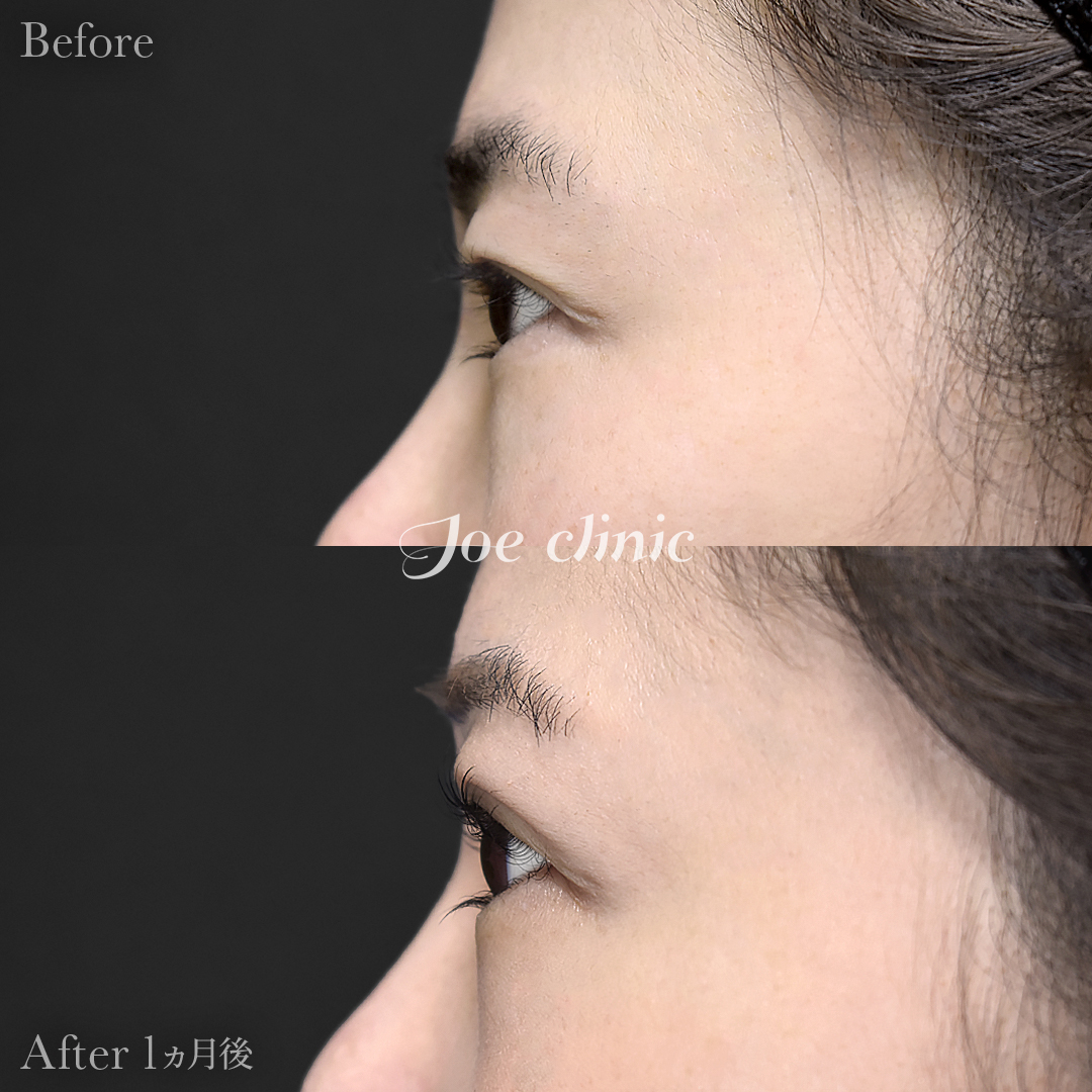 【30代女性】韓国式二重埋没法6点留め｜1ヵ月後