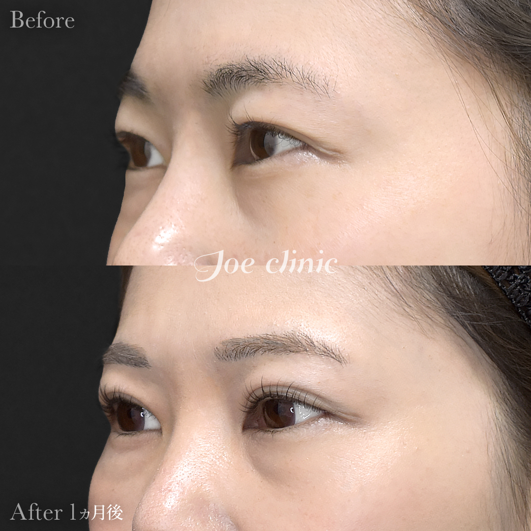 【30代女性】韓国式二重埋没法6点留め｜1ヵ月後