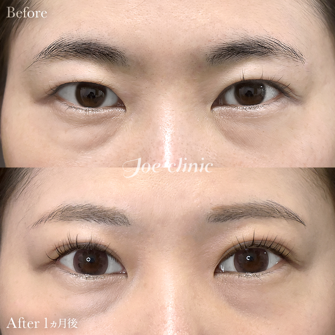 【30代女性】韓国式二重埋没法6点留め｜1ヵ月後