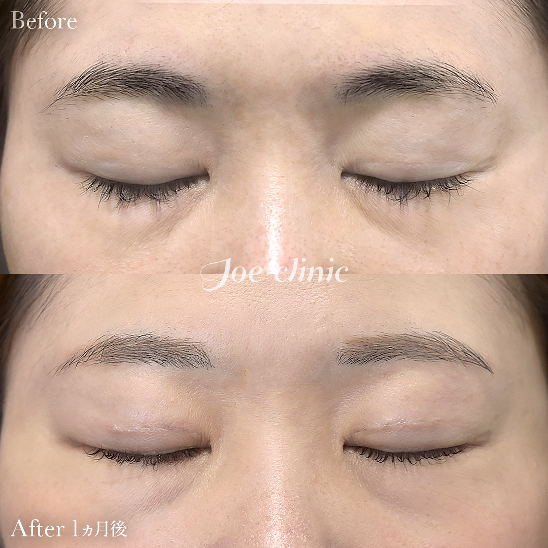 【30代女性】韓国式二重埋没法6点留め｜1ヵ月後