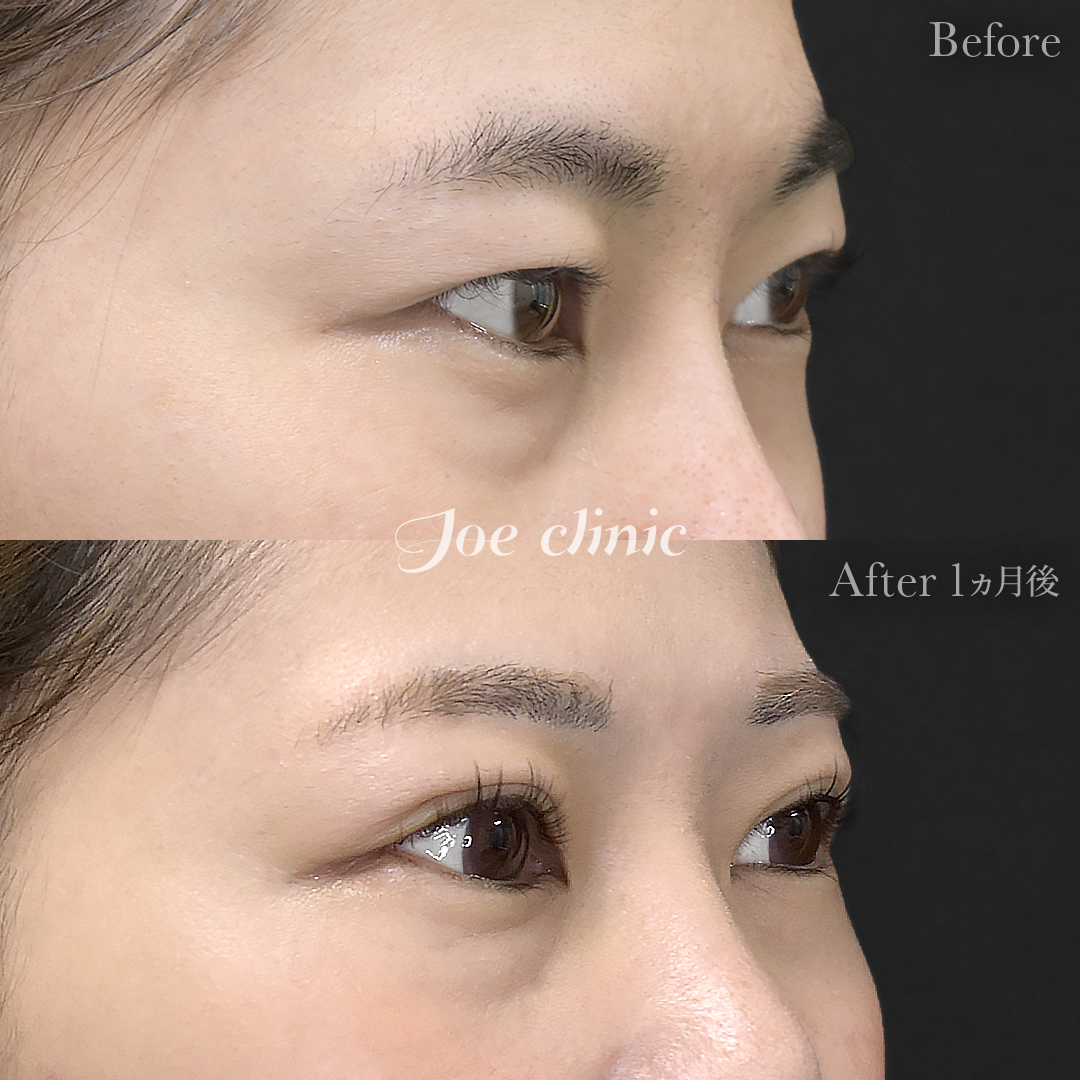 【30代女性】韓国式二重埋没法6点留め｜1ヵ月後