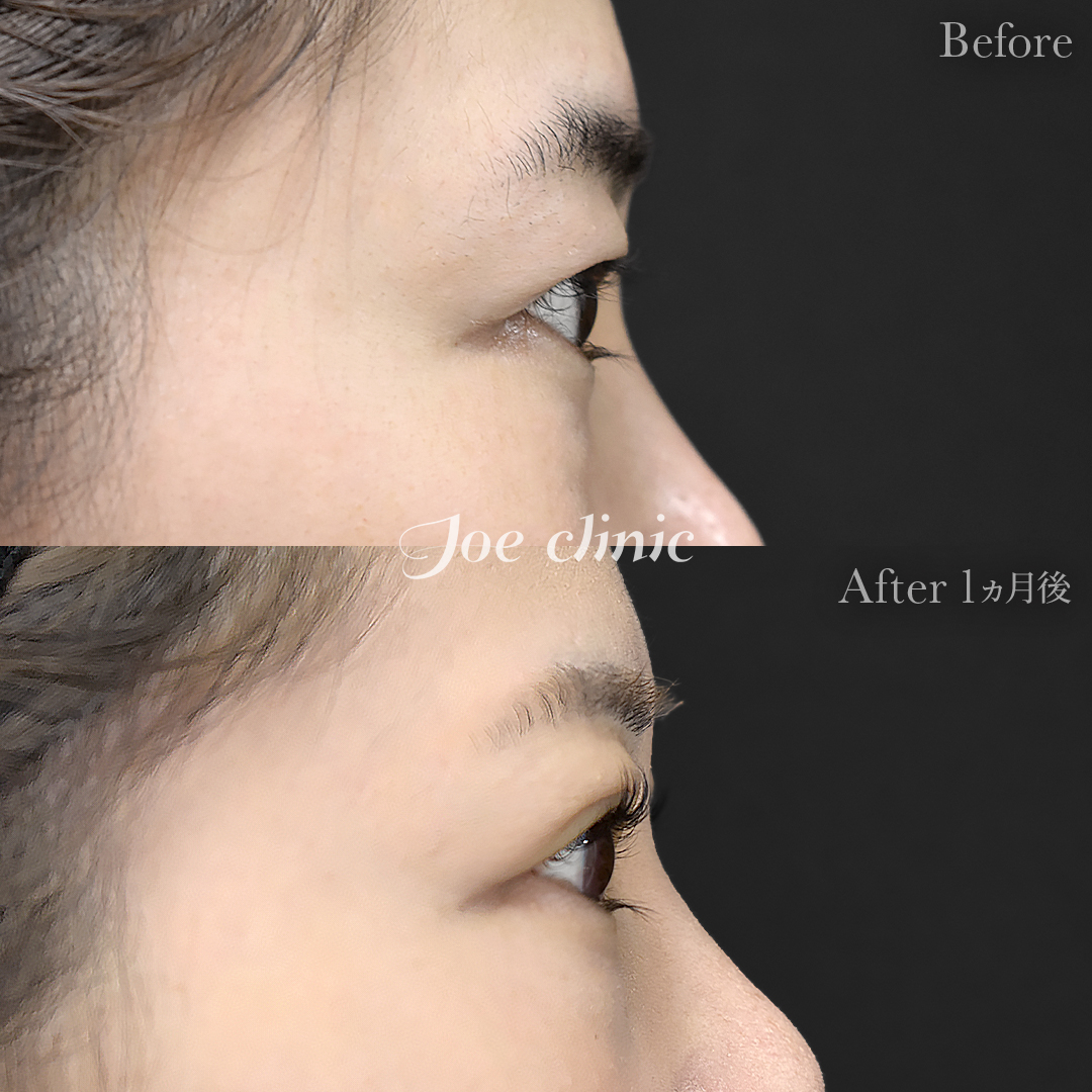 【30代女性】韓国式二重埋没法6点留め｜1ヵ月後