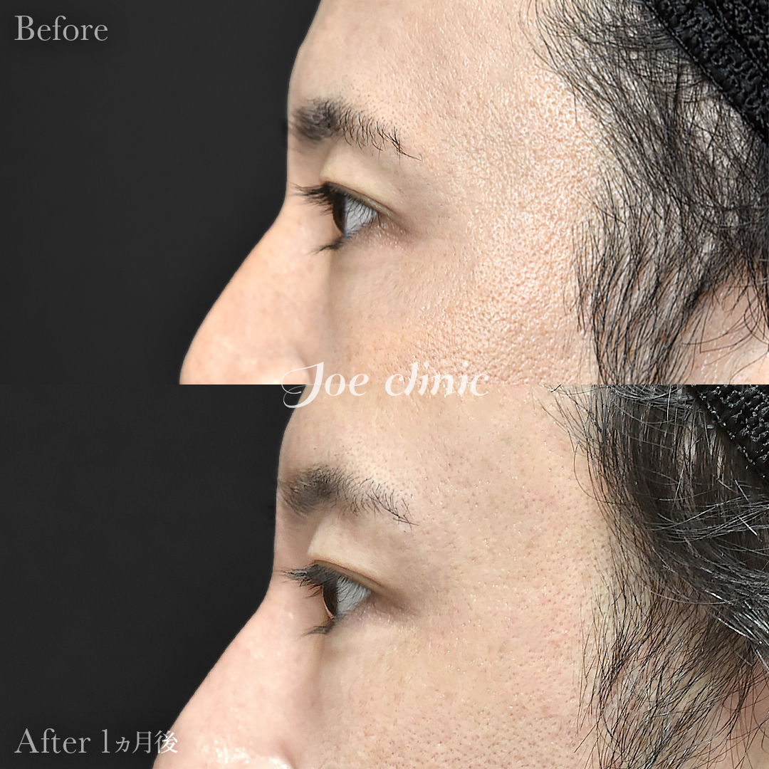 【30代男性】ジョウクリ式二重埋没法2点留め｜1ヵ月後