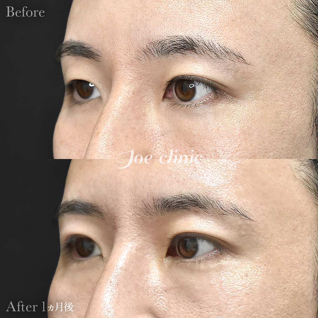 【30代男性】ジョウクリ式二重埋没法2点留め｜1ヵ月後