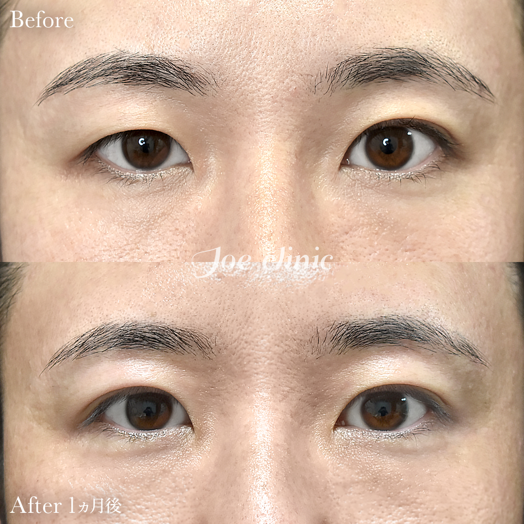 【30代男性】ジョウクリ式二重埋没法2点留め｜1ヵ月後