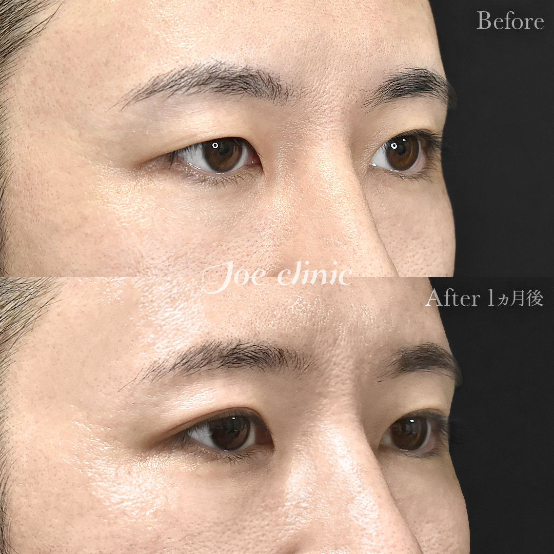 【30代男性】ジョウクリ式二重埋没法2点留め｜1ヵ月後