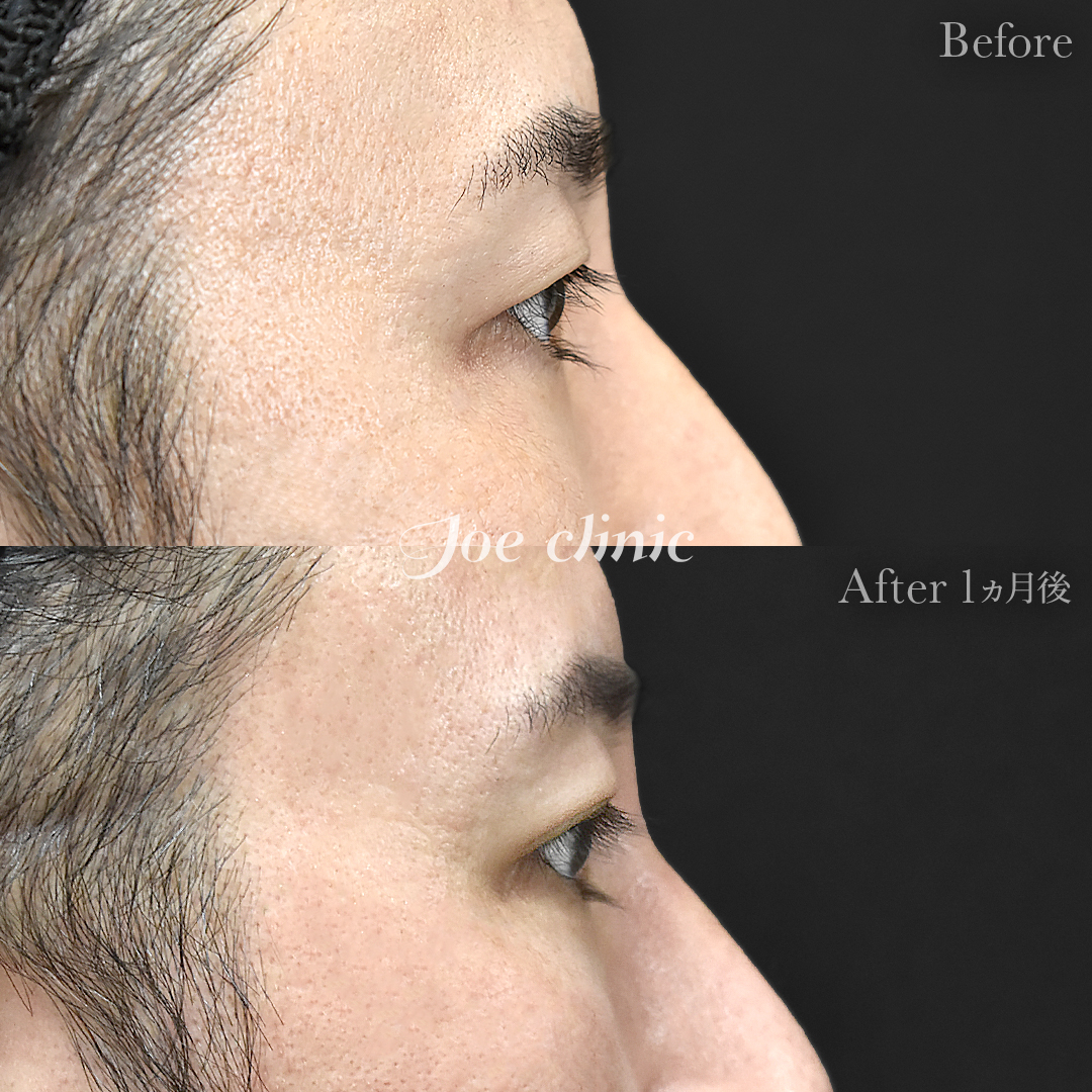 【30代男性】ジョウクリ式二重埋没法2点留め｜1ヵ月後