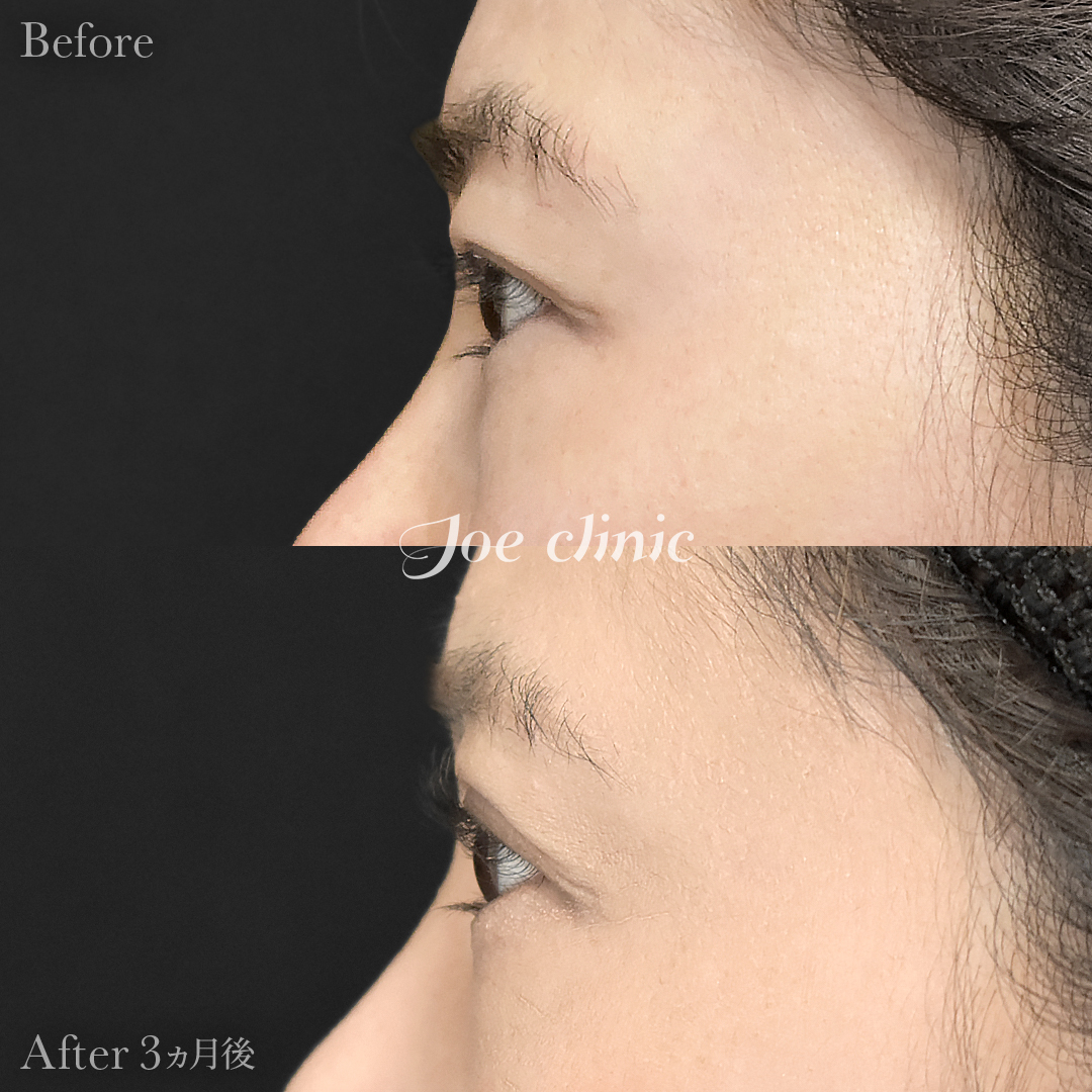 【30代女性】二重全切開法＋目の上たるみ取り術｜3ヵ月後
