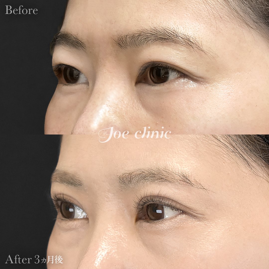 【30代女性】二重全切開法＋目の上たるみ取り術｜3ヵ月後