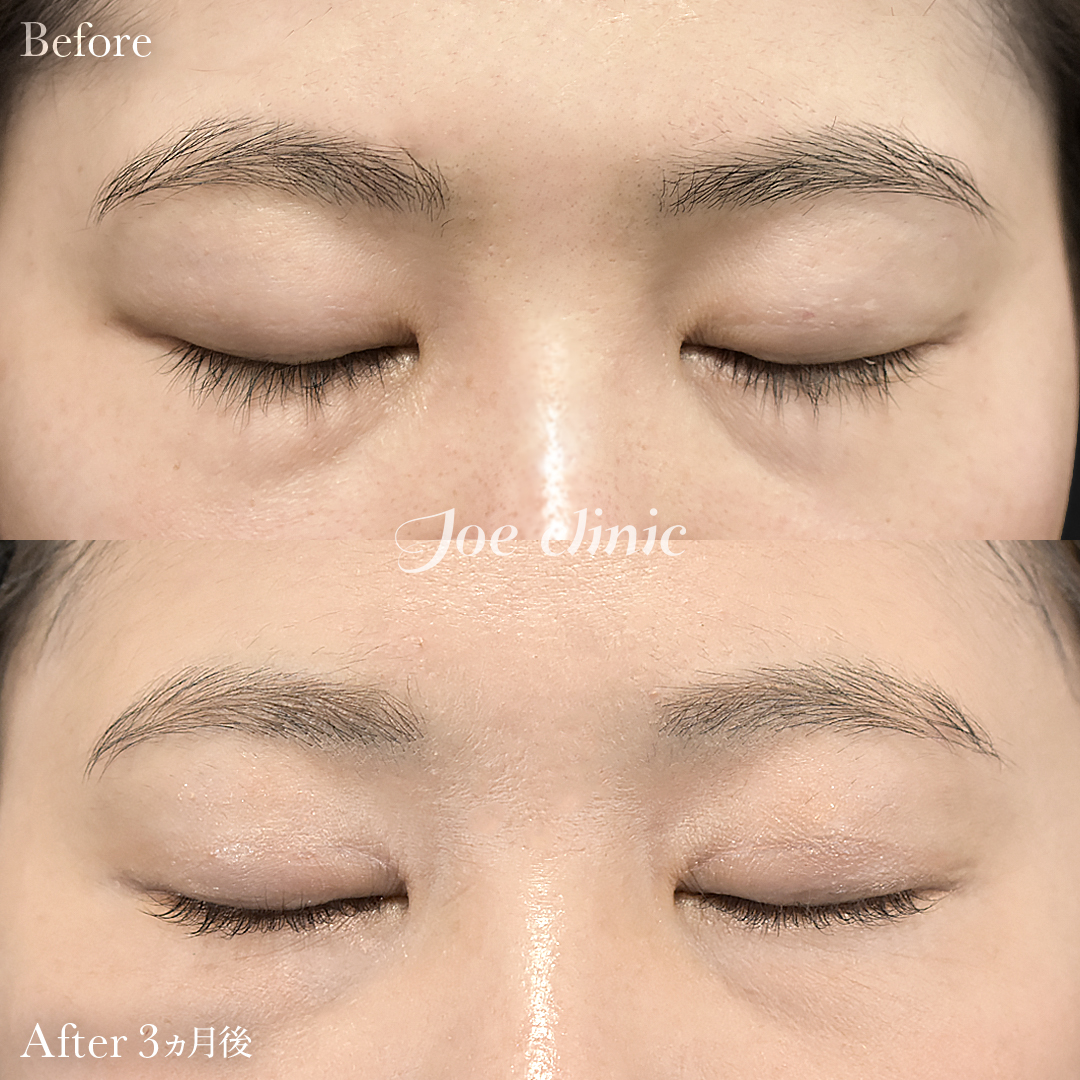 【30代女性】二重全切開法＋目の上たるみ取り術｜3ヵ月後