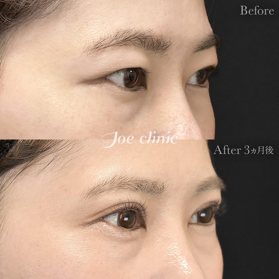 【30代女性】二重全切開法＋目の上たるみ取り術｜3ヵ月後