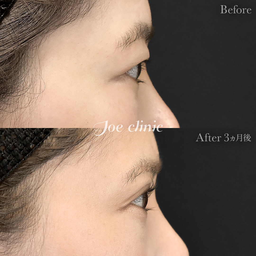 【30代女性】二重全切開法＋目の上たるみ取り術｜3ヵ月後