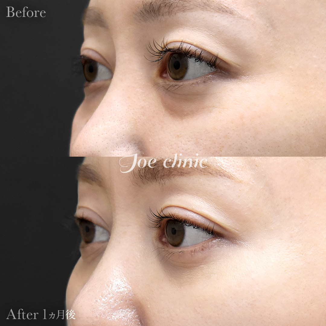 【30代女性】目の下のクマ取り（脂肪取り術）｜1ヵ月後