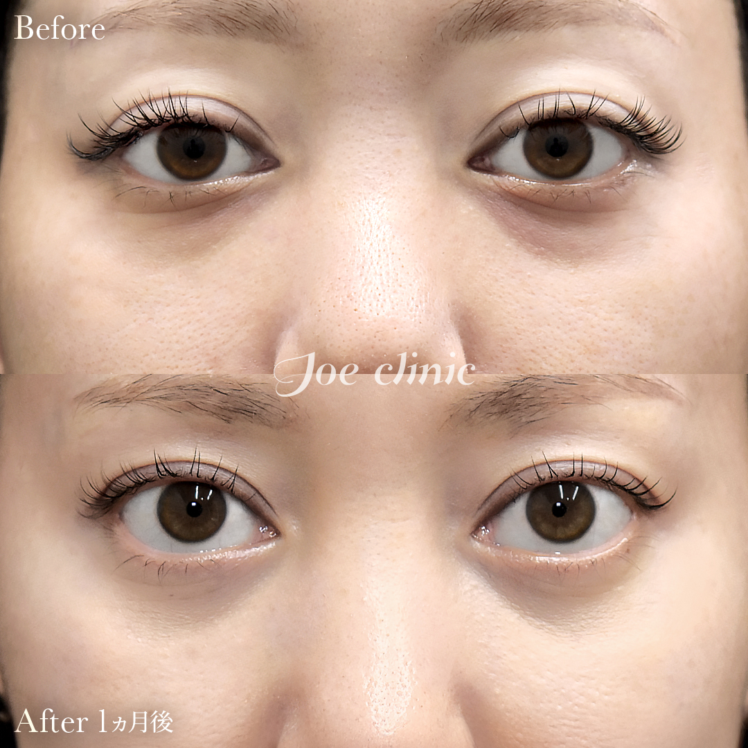 【30代女性】目の下のクマ取り（脂肪取り術）｜1ヵ月後