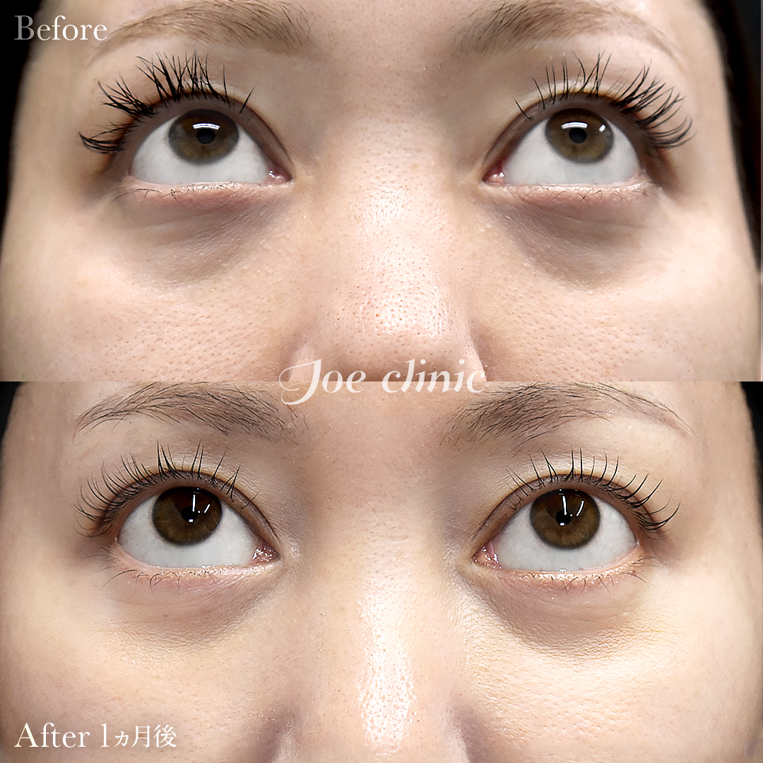 【30代女性】目の下のクマ取り（脂肪取り術）｜1ヵ月後