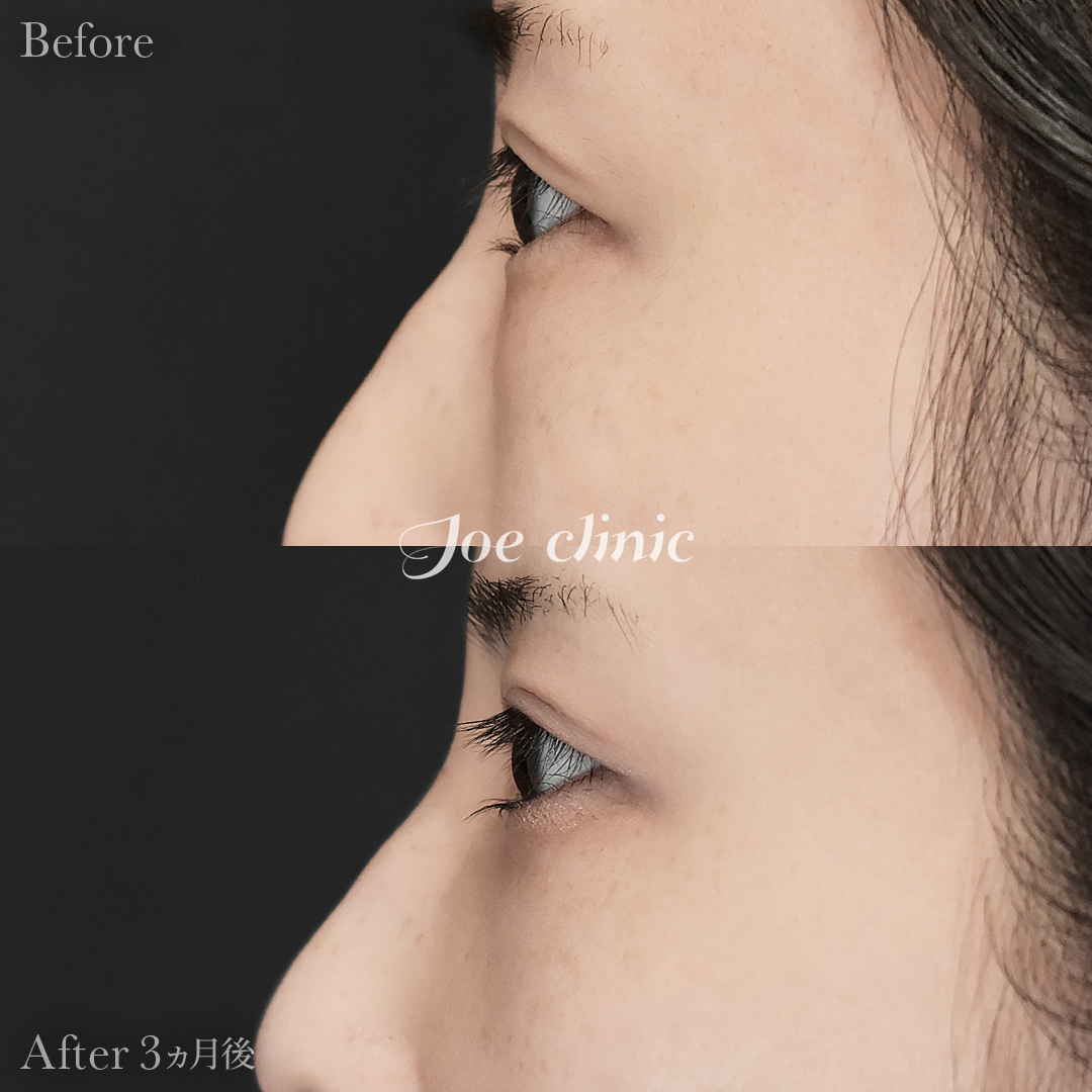 【20代女性】目の下のクマ取り（脂肪取り術）｜3ヵ月後