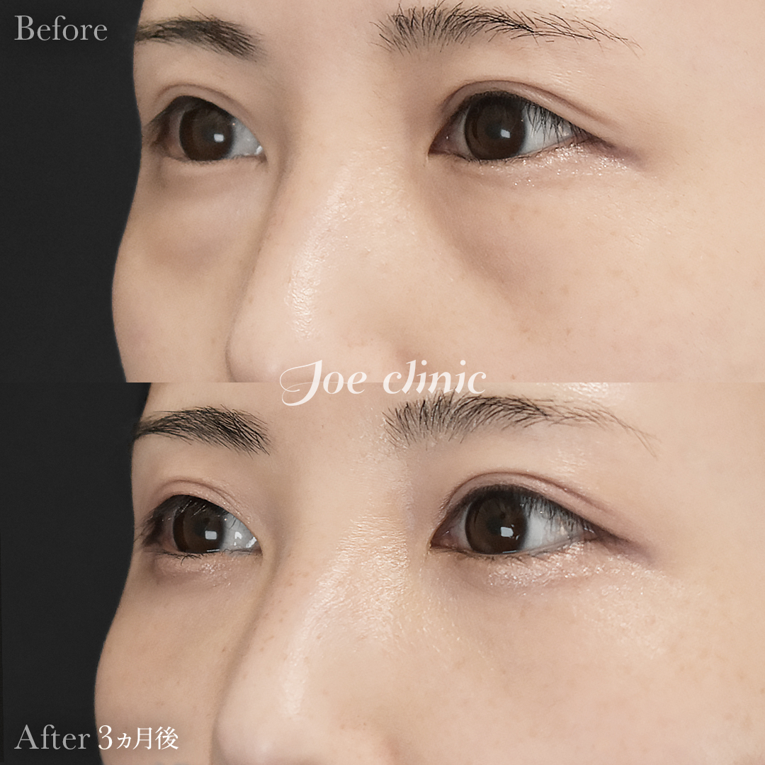 【20代女性】目の下のクマ取り（脂肪取り術）｜3ヵ月後