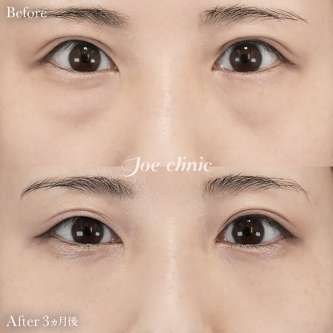 【20代女性】目の下のクマ取り（脂肪取り術）｜3ヵ月後