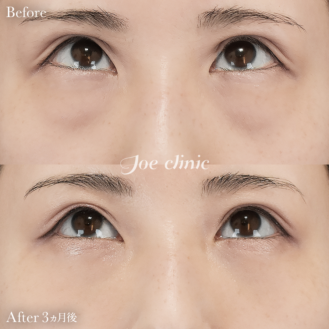 【20代女性】目の下のクマ取り（脂肪取り術）｜3ヵ月後