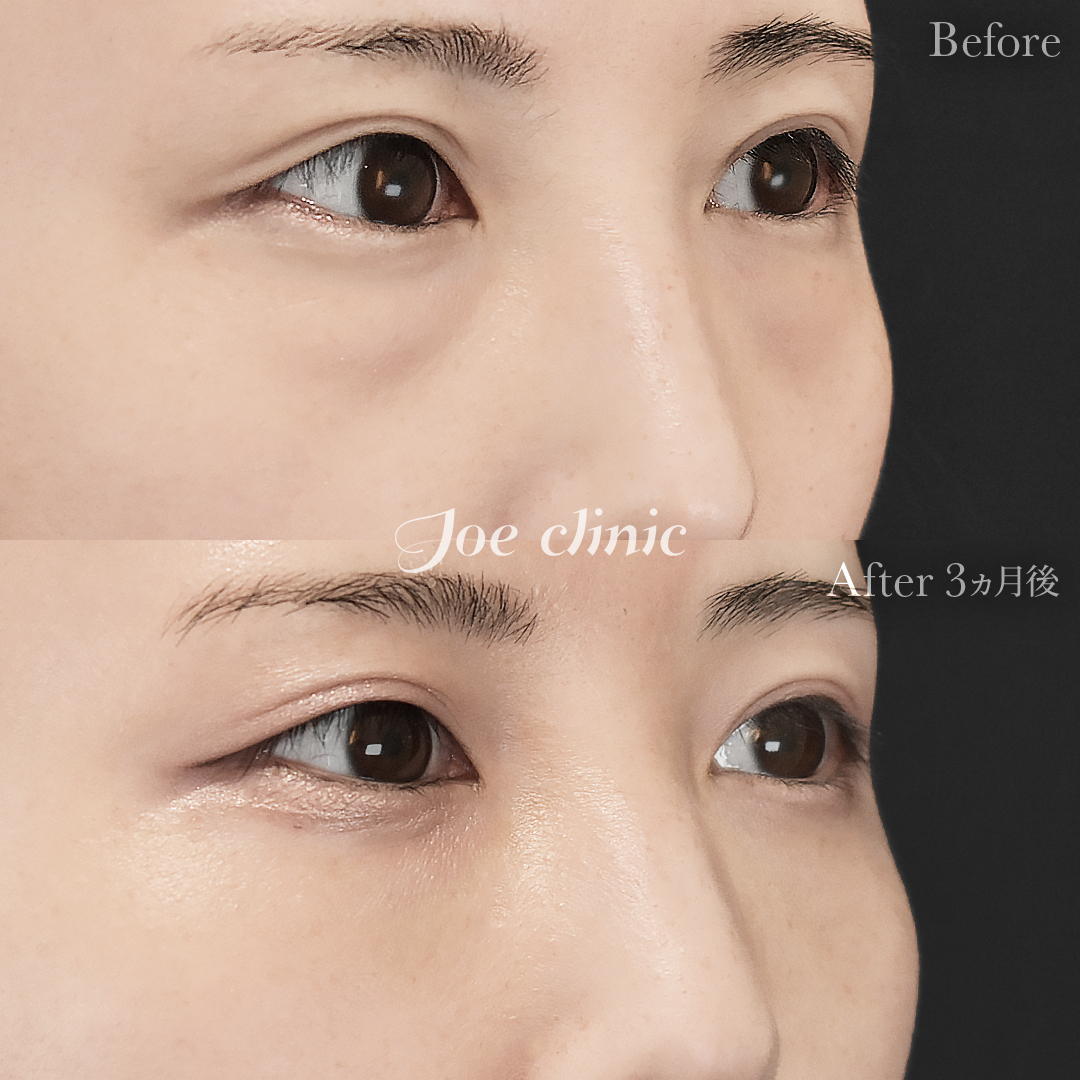 【20代女性】目の下のクマ取り（脂肪取り術）｜3ヵ月後