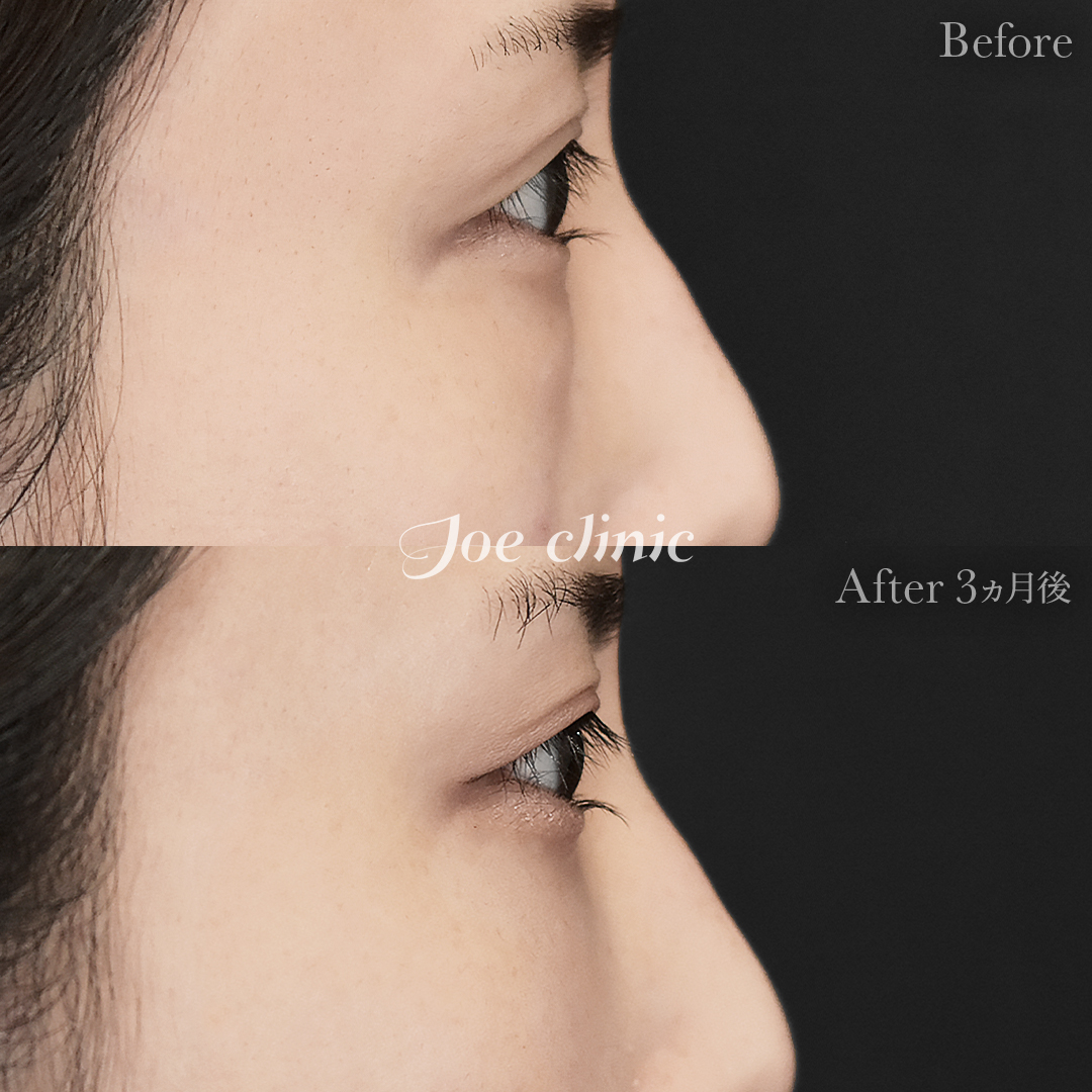 【20代女性】目の下のクマ取り（脂肪取り術）｜3ヵ月後