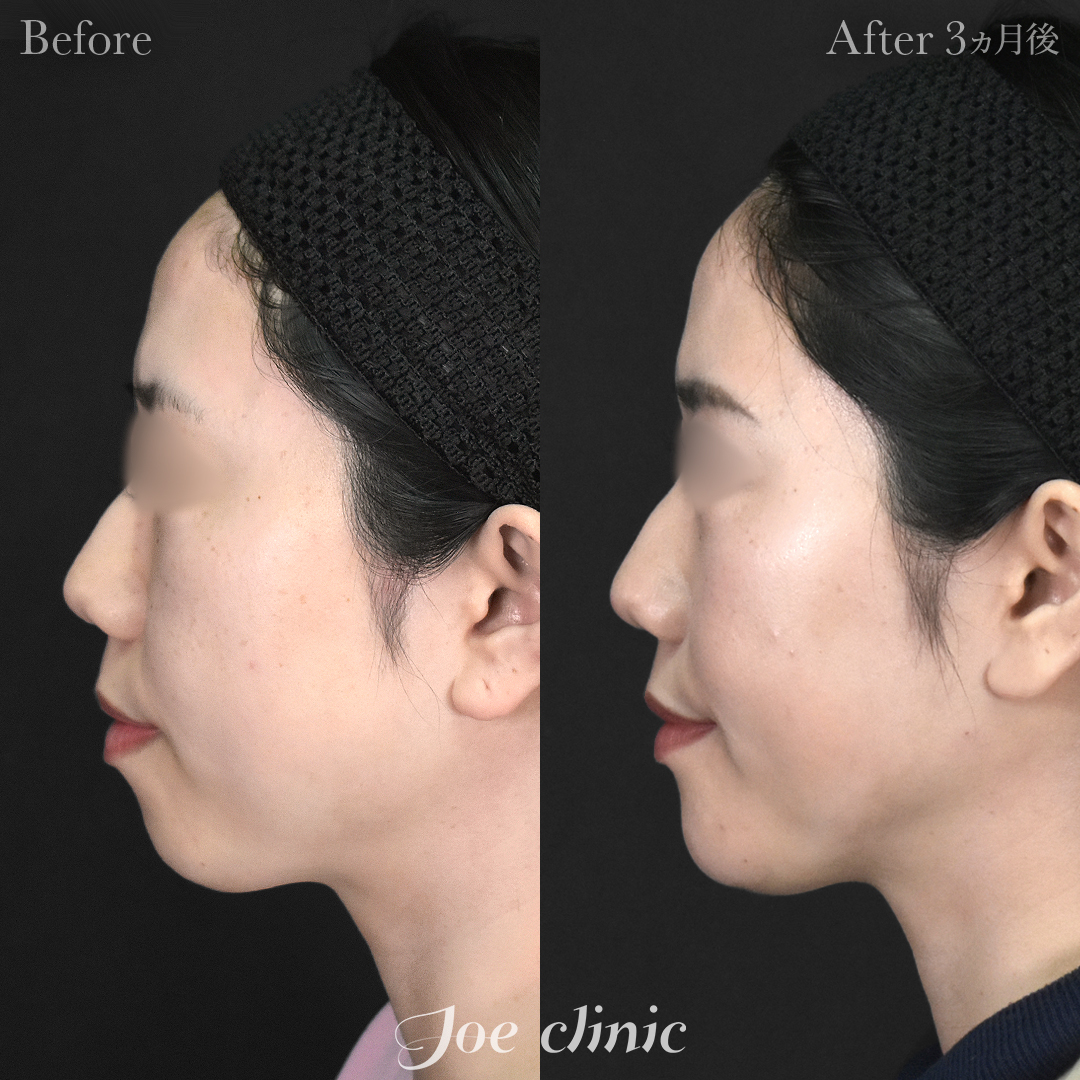 【30代女性】脂肪吸引(顔2部位)+エラボトックス注射+顎プロテーゼ挿入|3ヵ月後